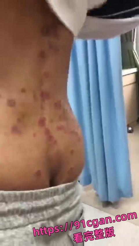 初三男生 年纪轻轻就集齐梅毒和艾滋于一身！这症状都3期了吧 还死不承认！