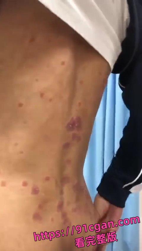 初三男生 年纪轻轻就集齐梅毒和艾滋于一身！这症状都3期了吧 还死不承认！