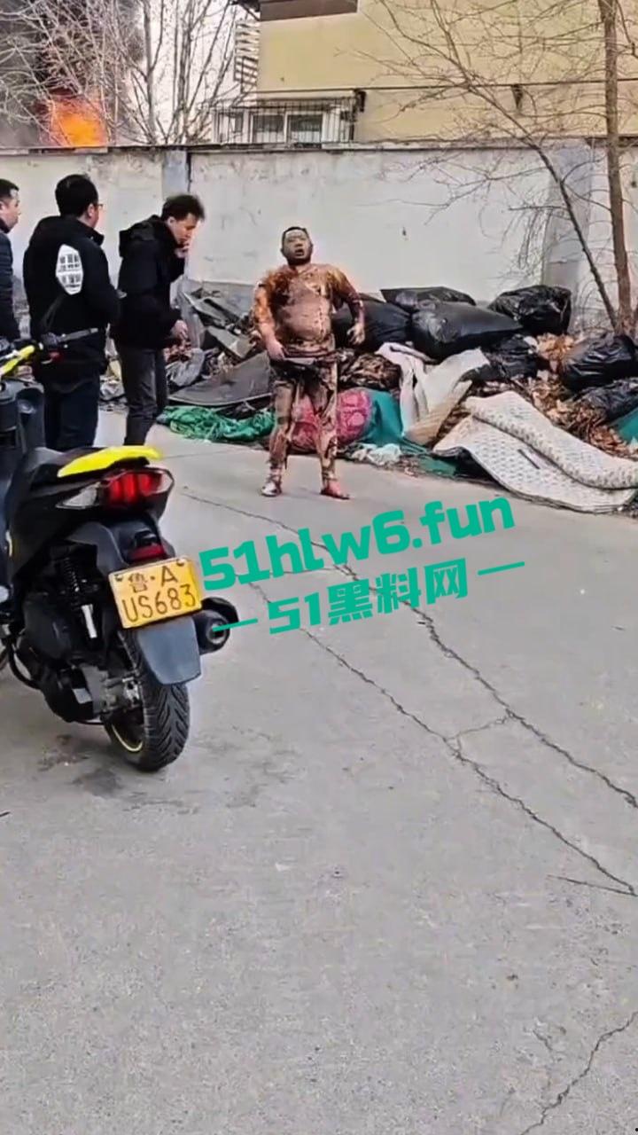 山东济南一小区发生火灾，男子被烧的体无完肤，经调查是邻居大妈积攒的废品导致烧成这样也太惨了。